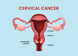 Cervical Cancer in Ghana: A Preventable Tragedy
